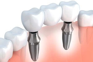 Implant Supported Bridge Graphic